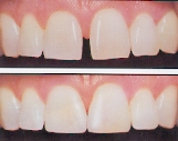 close gap between teeth