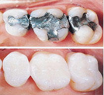 cerec fillings