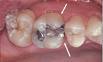amalgam fillings