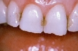 stained old fillings