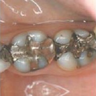 amalgam filling