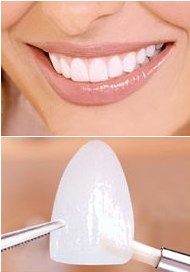 dental veneer dental veneer