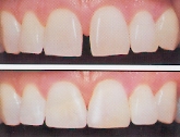 diastema/gap closed