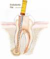 root canal therapy