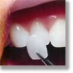 dental veneer dental veneer